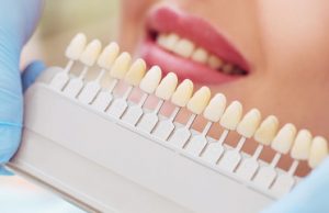 a tray of tooth colors being compared to a patient’s smile