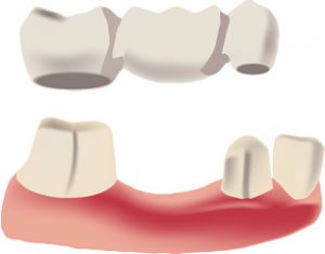 a bridge being placed over two teeth and one missing tooth