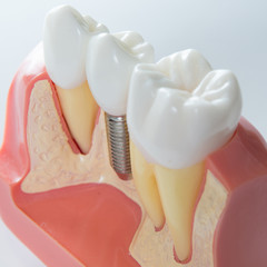 a dental implant in between two natural teeth